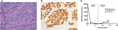Plasma Epstein-Barr Virus-Deoxyribonucleic Acid Copy Number Predicts Disease Progression in Stage I–III Pulmonary Lymphoepithelioma-Like Carcinoma